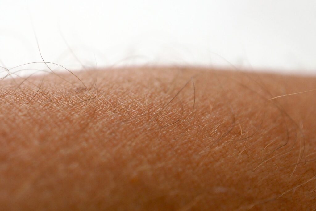 Haarfarbe und Hauttyp bei Laser-Haarentfernung entscheidend